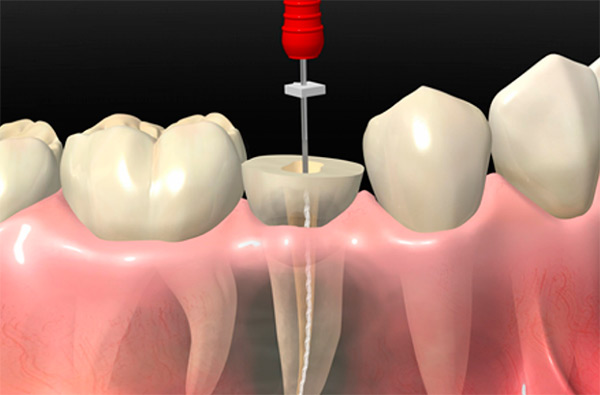 Лікування зубних каналів